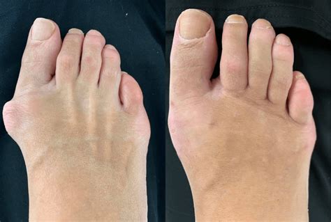 Bunion Surgery Before and After | Northwest Surgery Center Wisconsin