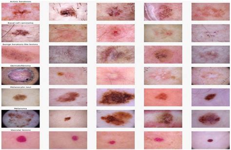 Melanoma Skin Cancer Stages