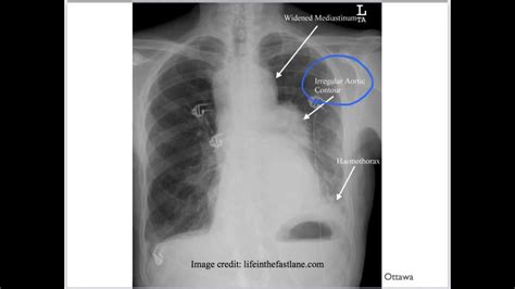 Aortic Dissection - Part 2 - YouTube