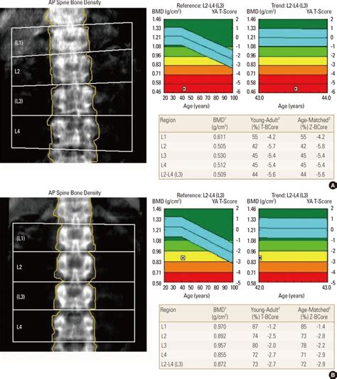 Normal Bone Density Chart By Age