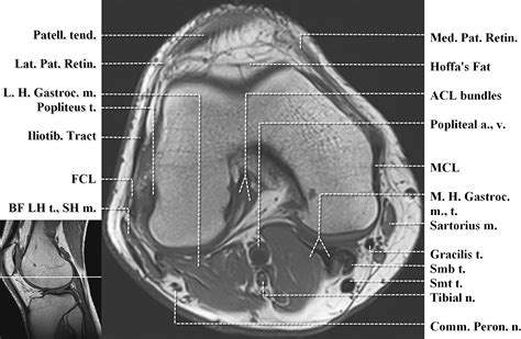 Knee Muscle Anatomy Mri Mri Knee Joint Anatomy Knee Muscle Anatomy ...