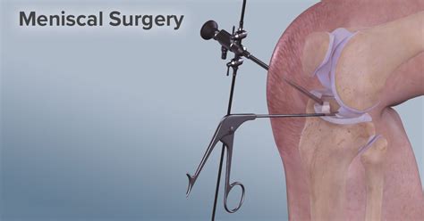 Knee Meniscus Tear Surgery