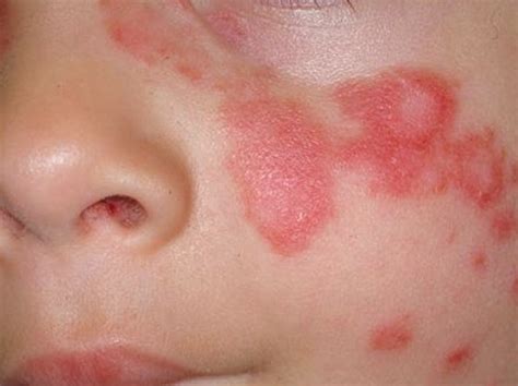 👉 Discoid Lupus - Pictures, Symptoms, Treatment, Causes (December 2021)