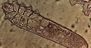 Demodex Mites Treatment in Humans ~ DEMODICOSIS