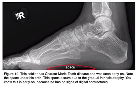 Treating Deformities in Athletes: Pes Cavus and Pes Planus | Podiatry Today