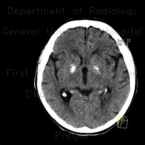 Radiology case: Calcification in basal ganglia