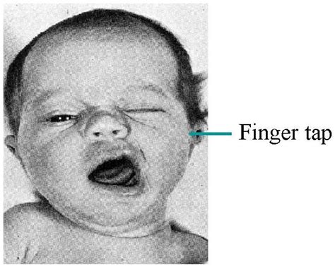 Latent Tetany Signs - Medical Show