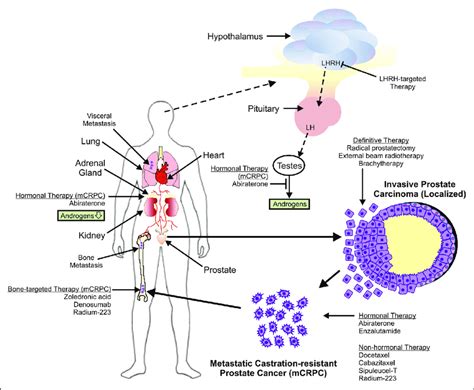 Treatment options for localized and metastatic prostate cancer and the ...