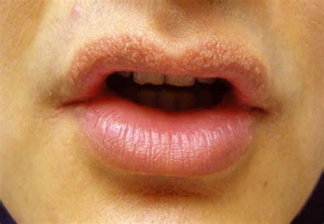 👉 Bumps on Lips - Causes, Treatment, Pictures (December 2021)