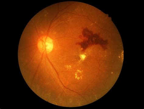 Diabetic Retinopathy