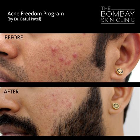 Acne Scar Treatment in Mumbai | The Bombay Skin Clinic