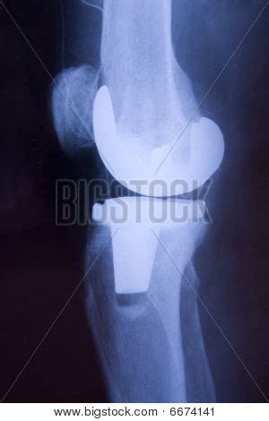 Knee Joint Replacement Image & Photo (Free Trial) | Bigstock