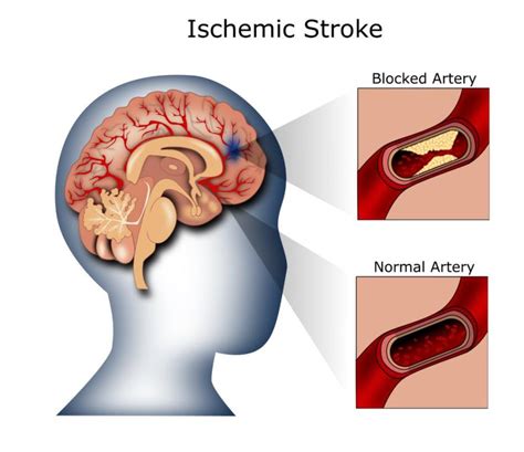 Illustration of ischemic stroke. | Download Scientific Diagram