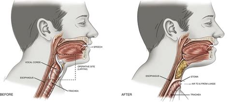 Voice Rehabilitation after Laryngeal Cancer | Ento Key