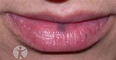 Labial melanotic macule image