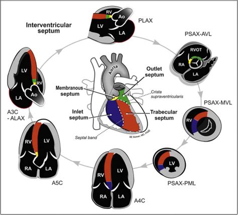 Ventricular Septal Defect Echo