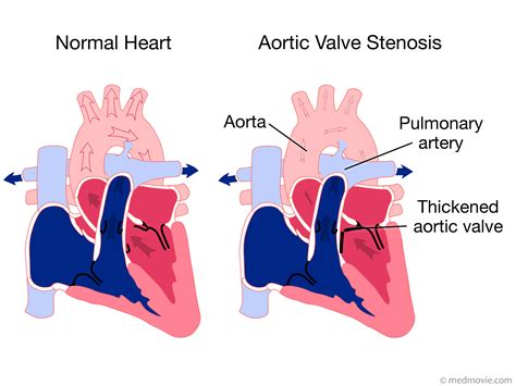 Aortic Valve Stenosis