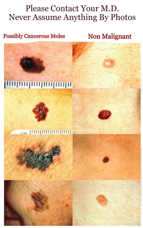 Difference in Moles And Skin Cancer: What You Need to Know About ...