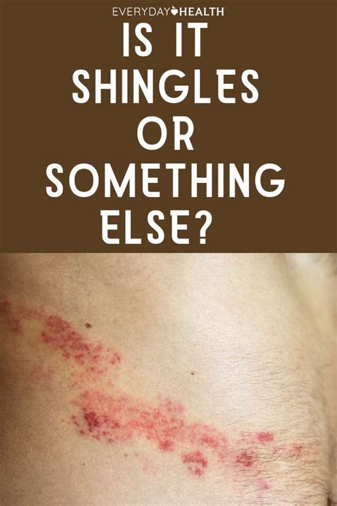 Is It Shingles or Something Else?