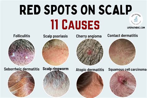 Red Spots on Scalp: 11 Causes, Pictures and Treatment