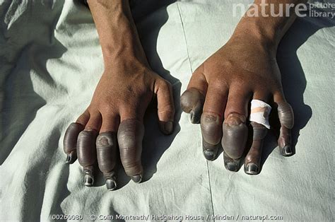 Stock photo of Andy Henderson's frostbitten fingers, photographed in ...