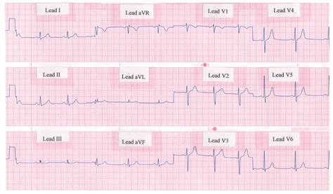 Lead Surface Electrocardiogram Ecg Of Typical Atrial Flutter | The Best ...