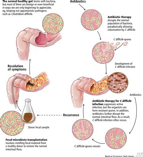 Figure 1 from Fecal microbiota transplantation for recurrent C ...