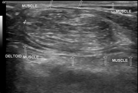 Intramuscular Lipoma Ultrasound