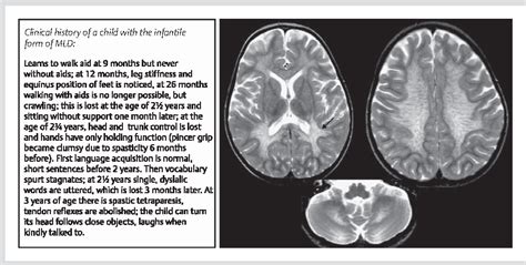 Figure 3 from Metachromatic leukodystrophy--an update. | Semantic Scholar