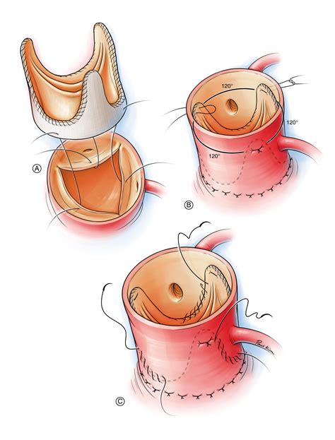 Aortic Valve Replacement (Mechanical, Bioprosthetic, Stentless) | Adult ...