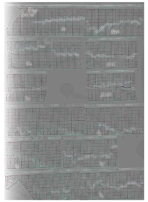 reveals generalized nonspecific repolarization abnormalities | Download ...