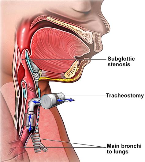 Tracheostomy - Procedure, Care, Tracheostomy Complications