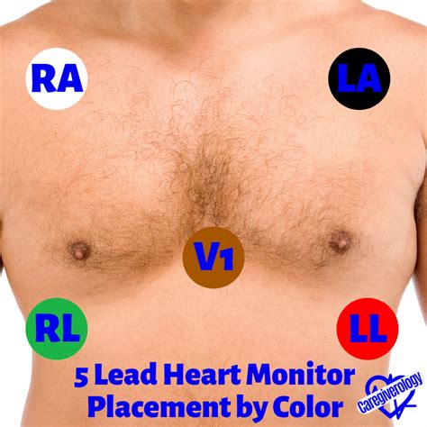 Holter Monitor 5 Lead Placement Diagram - Wiring Diagram