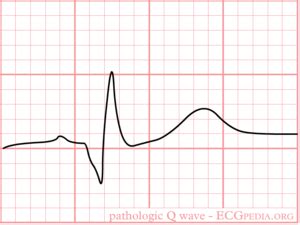 Pathologic Q Waves - ECGpedia