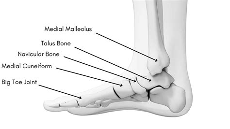 Medial Malleolus Fracture | Medial Malleolus Avulsion Fracture