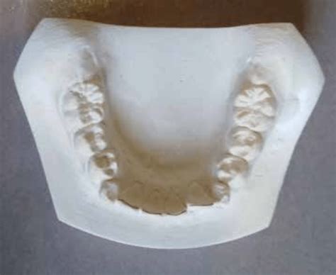 Tanaka and Johnston method for mixed dentition analysis. Tanaka and ...