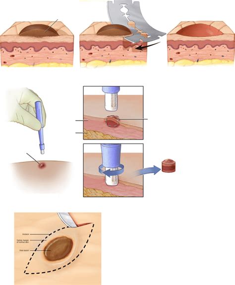 Skin Punch Biopsy Procedure