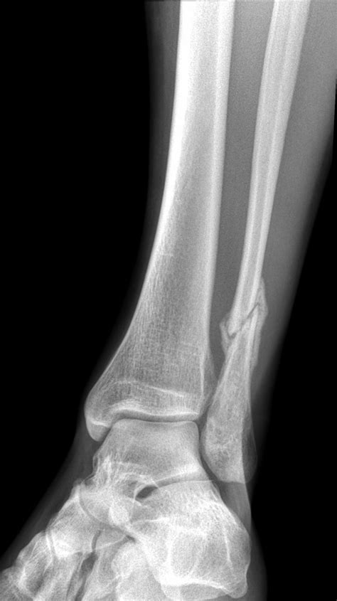 Fibula fracture - ebnipod