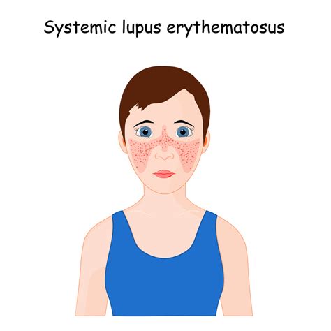 Top 8 Early Signs of Lupus And Butterfly Rash