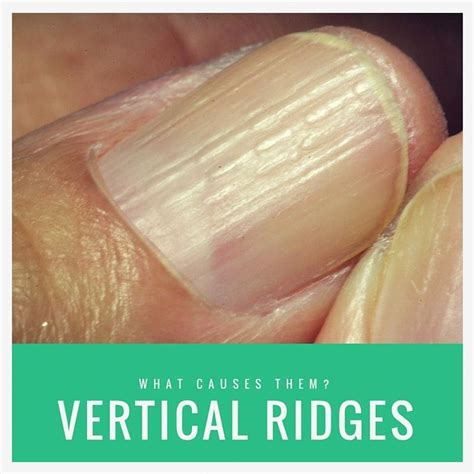 Onychorrhexis are vertical ridges on the nails. They develop with age ...