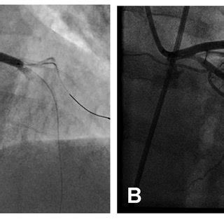 A bare metal stent is implanted in the proximal portion of LAD to the ...