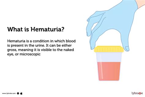 Hematuria: Causes, Symptoms, Treatment and Cost