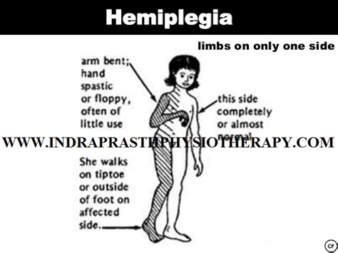 INDRAPRASTH PHYSIOTHERAPY CENTRE: HEMIPLEGIA