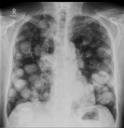 Cannonball metastases - colorectal cancer - Radiology at St. Vincent's ...