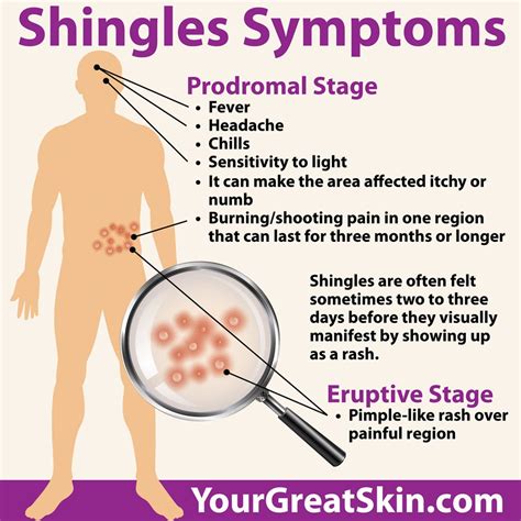 Shingles Symptoms Treatment