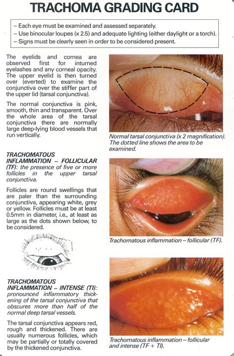 Control of Neglected Tropical Diseases