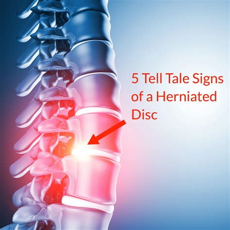 Herniated Disc Symptoms