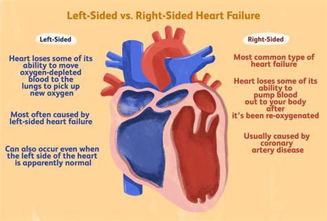 Mike Draws Nursing Left-sided Heart Failure Right-sided, 59% OFF