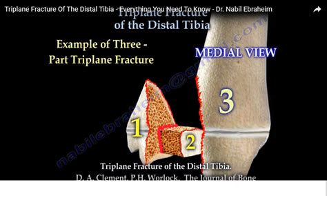 Triplane Fracture of Ankle — OrthopaedicPrinciples.com