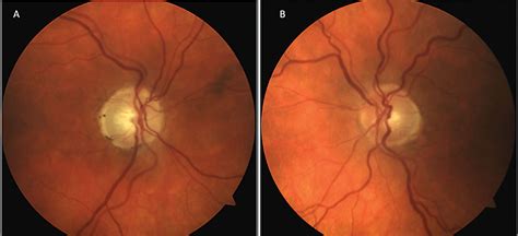 Photos Of Glaucoma Optic Nerve Cupping